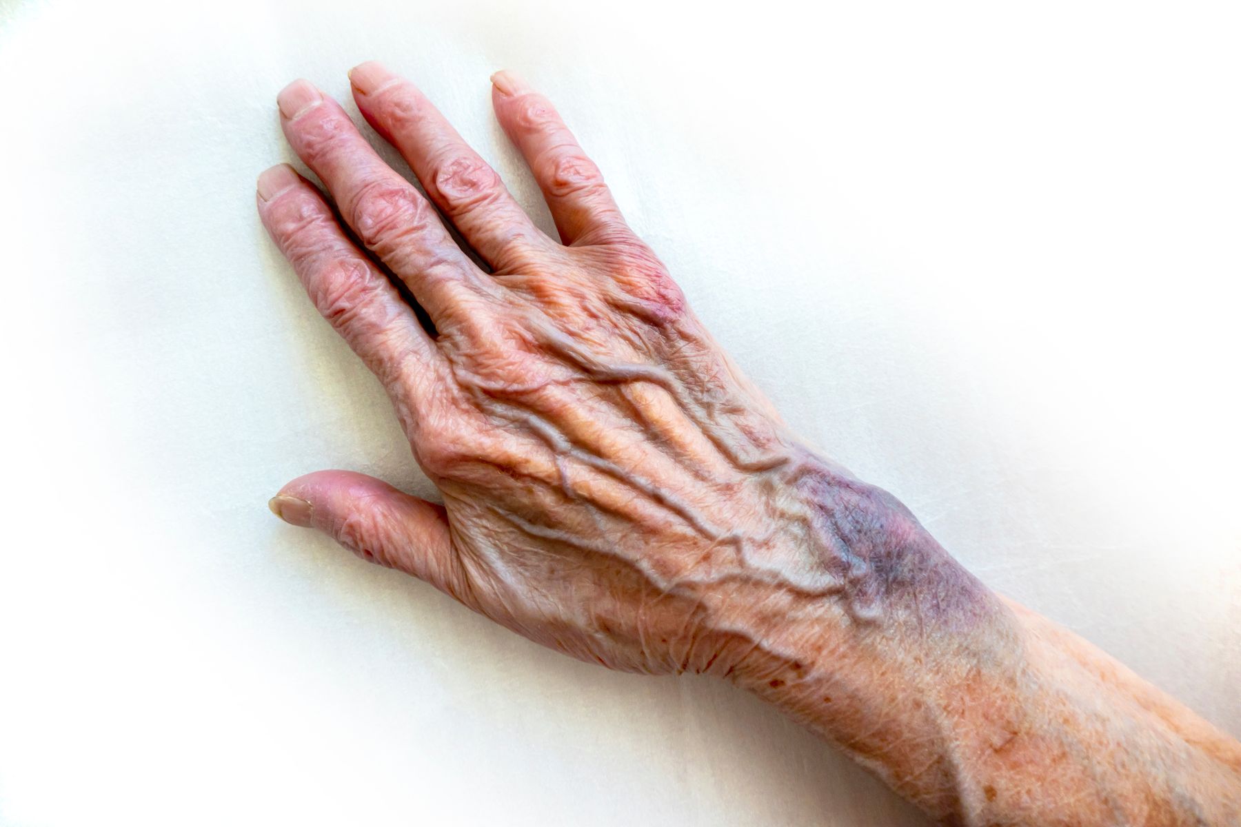 Hématome sous-cutané sur la main d'une senior